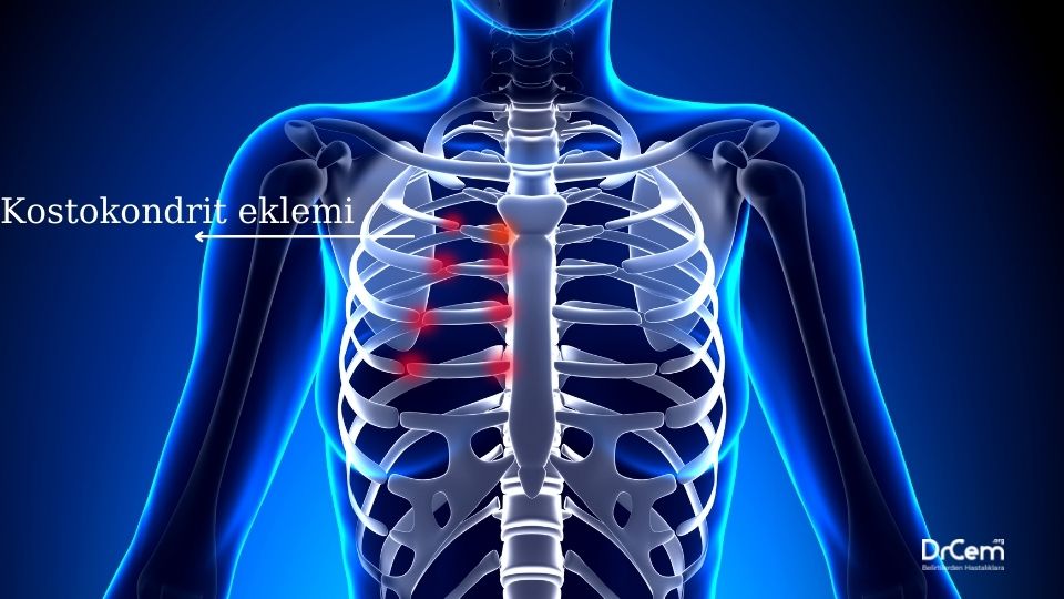 Tietze Sendromu görseli - DrCem hastalık rehberi